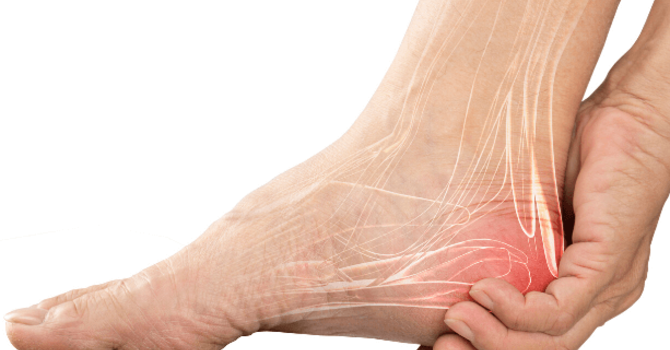 Plantar Fasciitis, Heel Pain, and Physiotherapy image