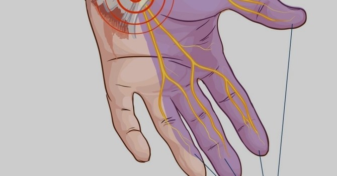 Understanding and Alleviating Wrist and Hand Pain: Carpal Tunnel Syndrome Unveiled image